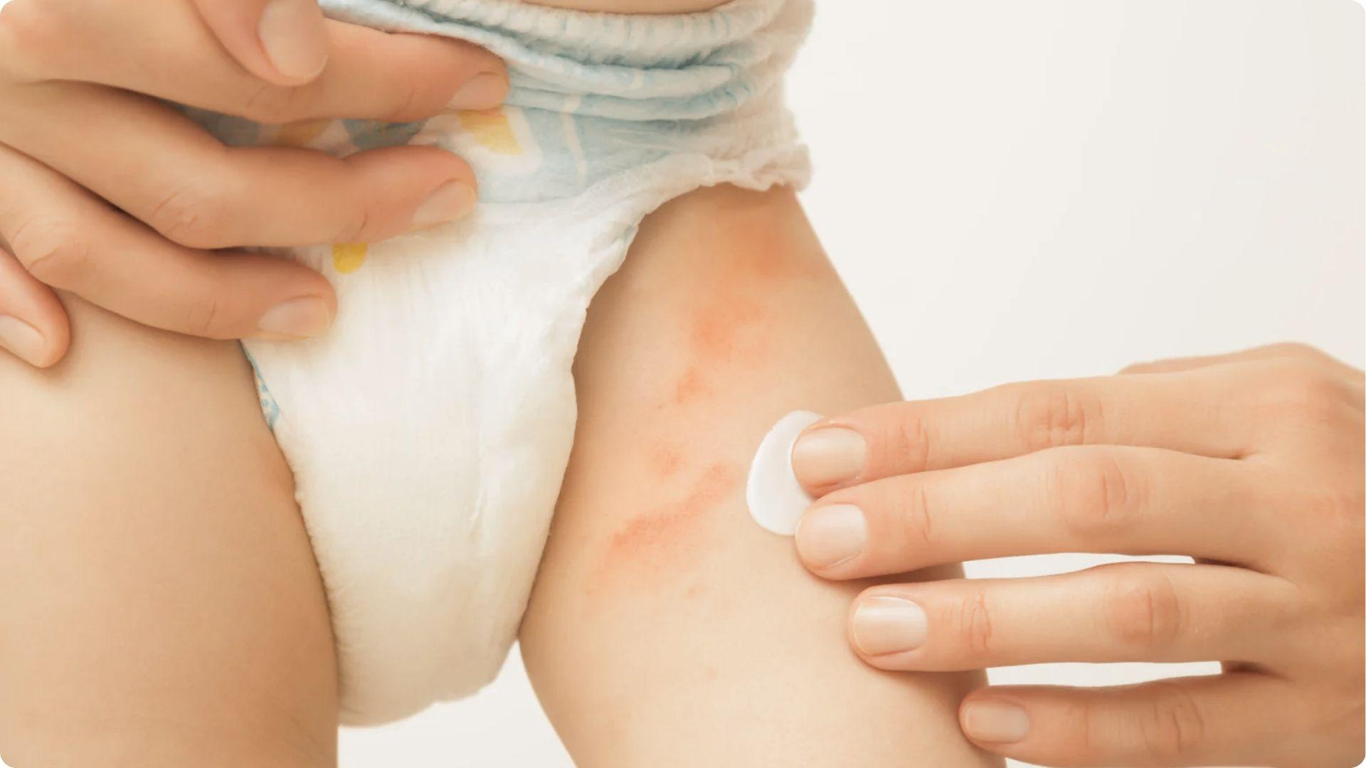 Adult applying antifungal cream to baby’s red irritated skin to heal yeast diaper rash